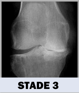 Arthrose - Stade 3