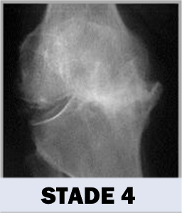 Arthrose - Stade 4