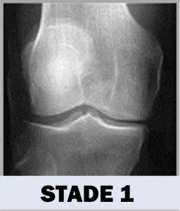 Arthrose - Stade 1